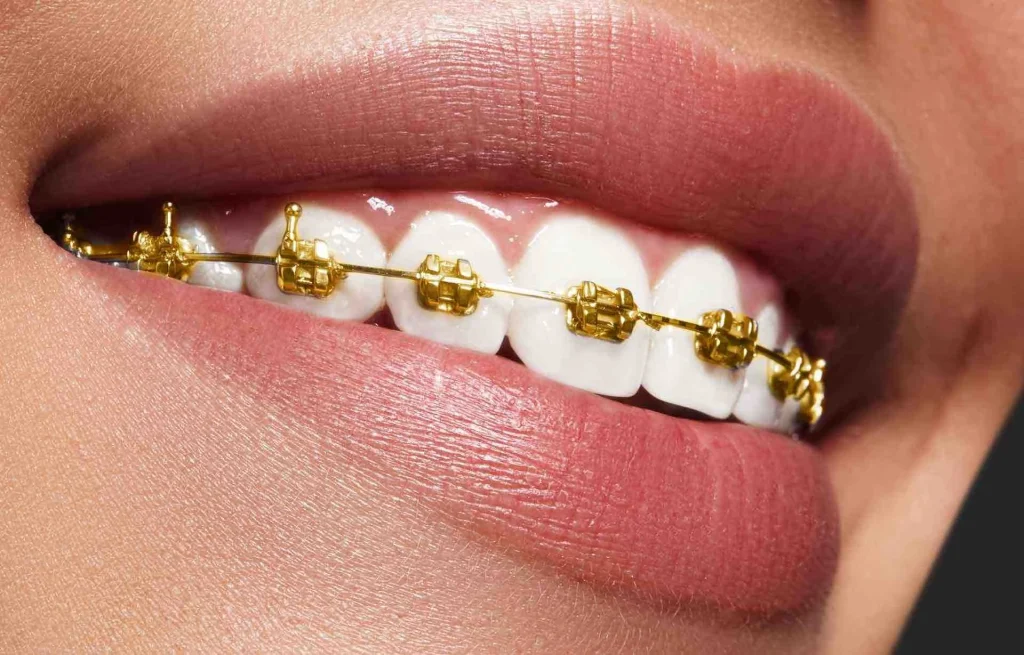 gold-braces-guide.jpg