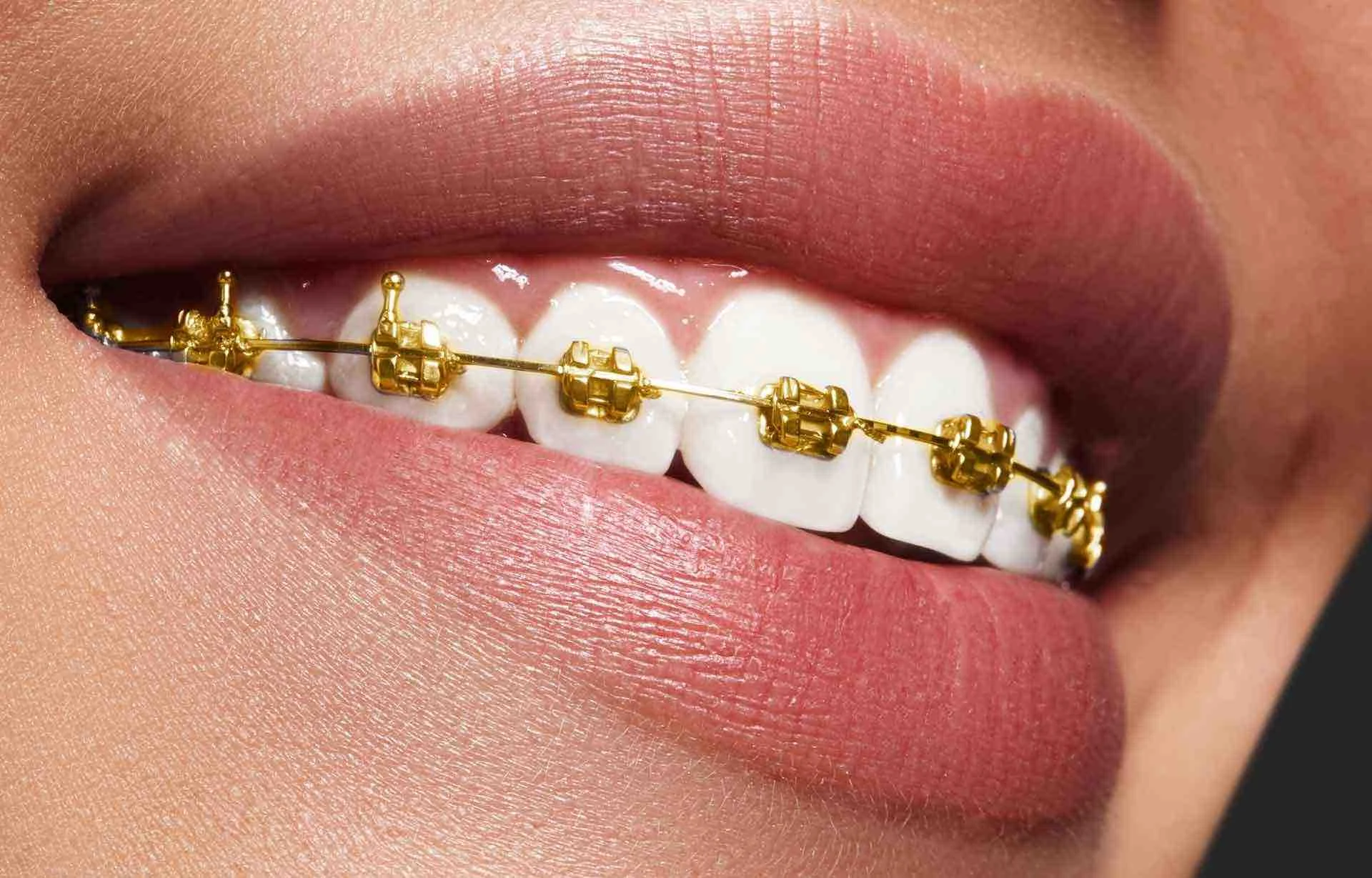 gold-braces-guide.jpg